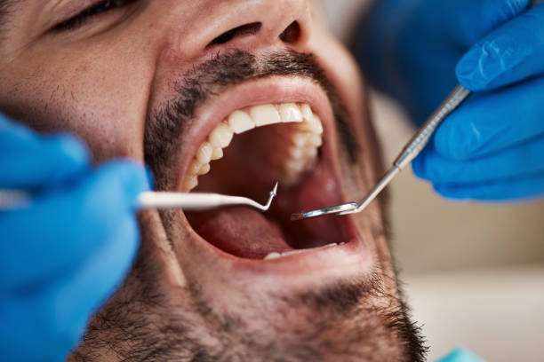 Best Chipped Tooth Repair Near Me  in Lyman, MS